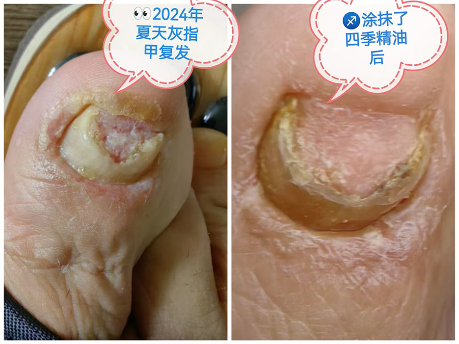2026072212607785.jpg 灰指甲1.jpg