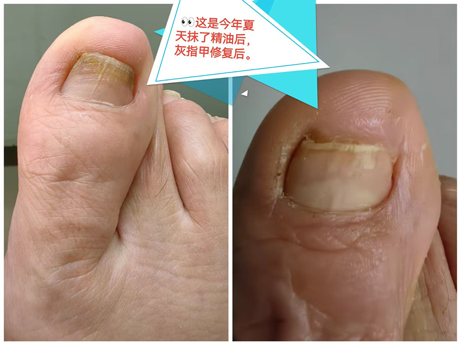 2026072217178127.jpg 灰指甲2.jpg
